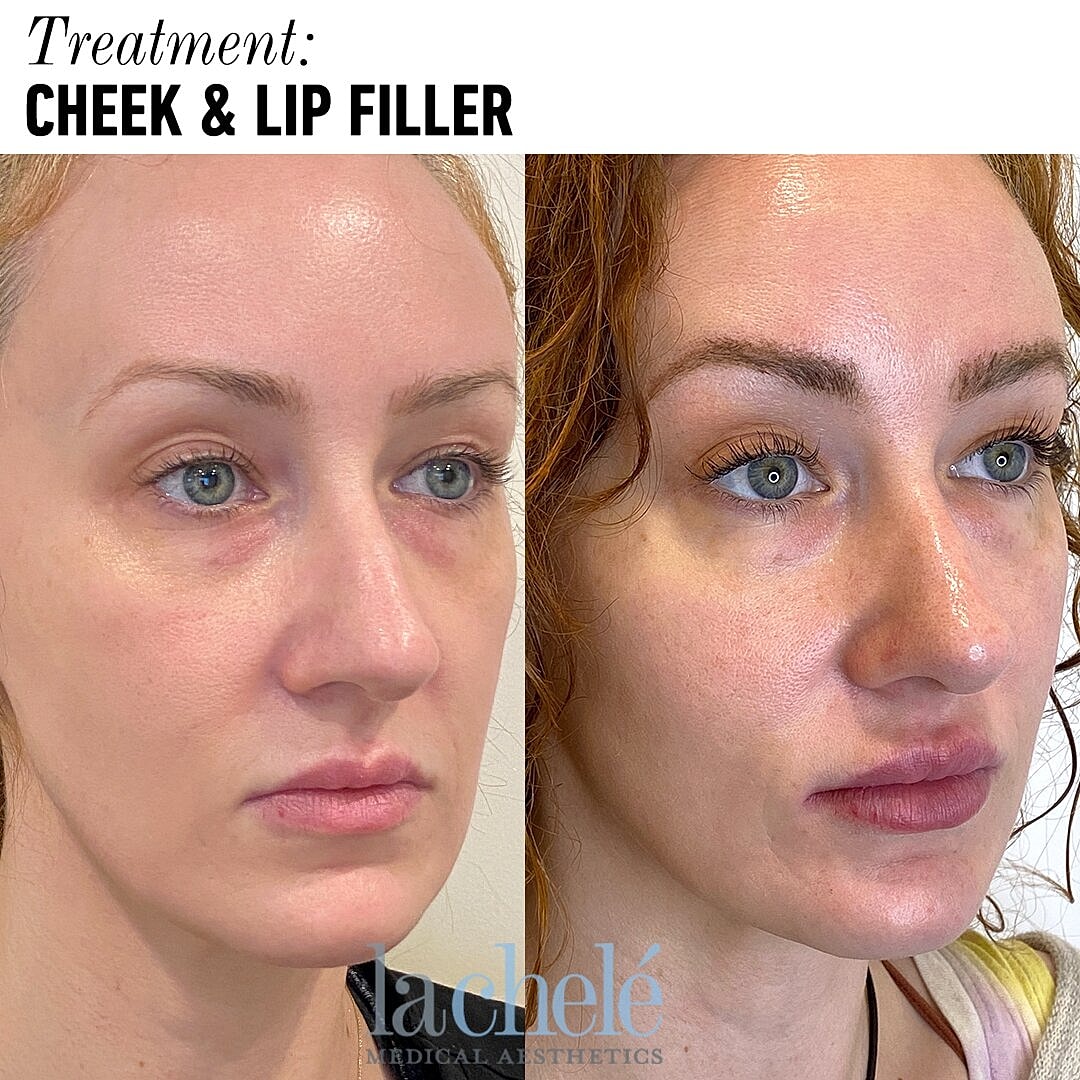 What is the difference between Botox and Filler?