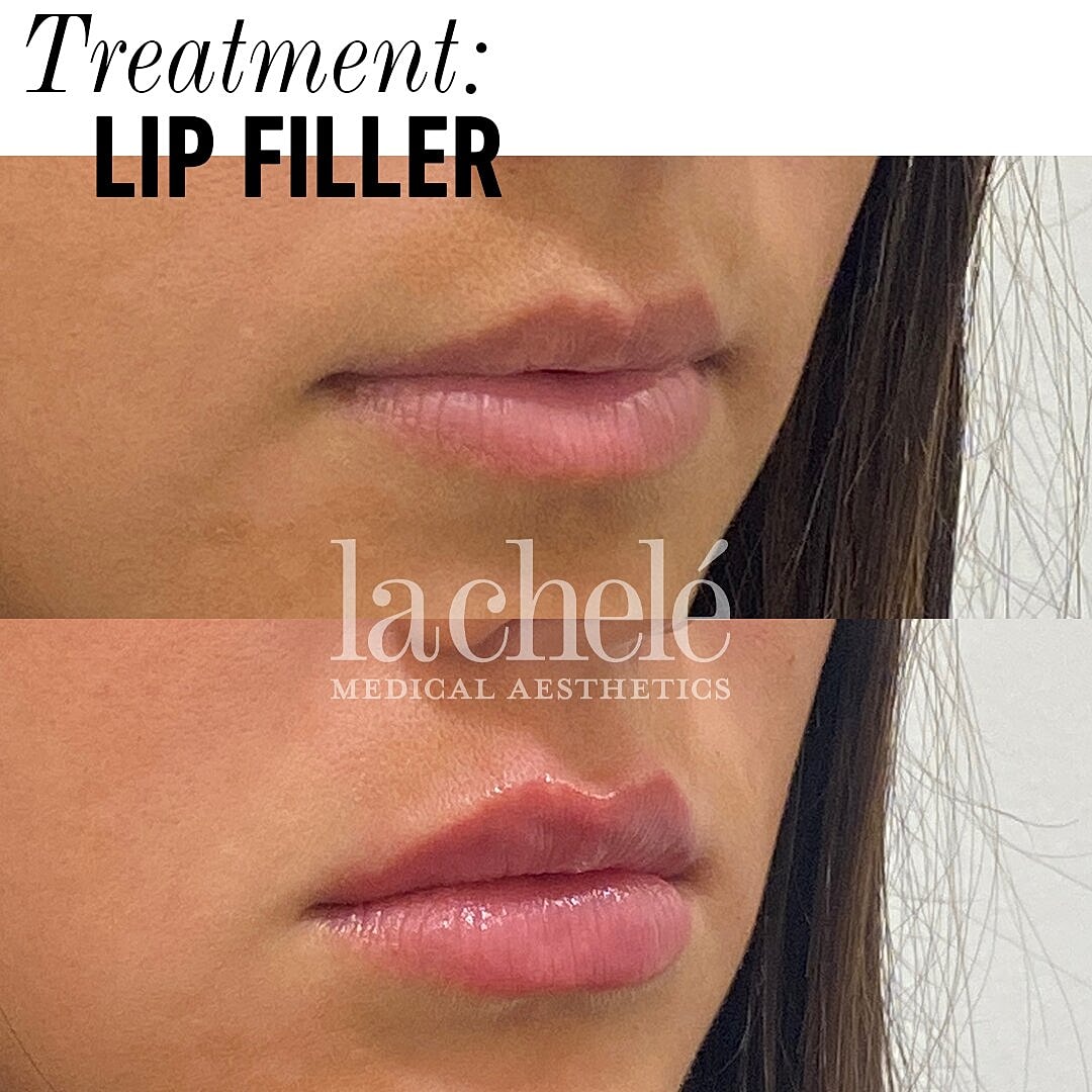 Your Questions Answered | Lip Filler