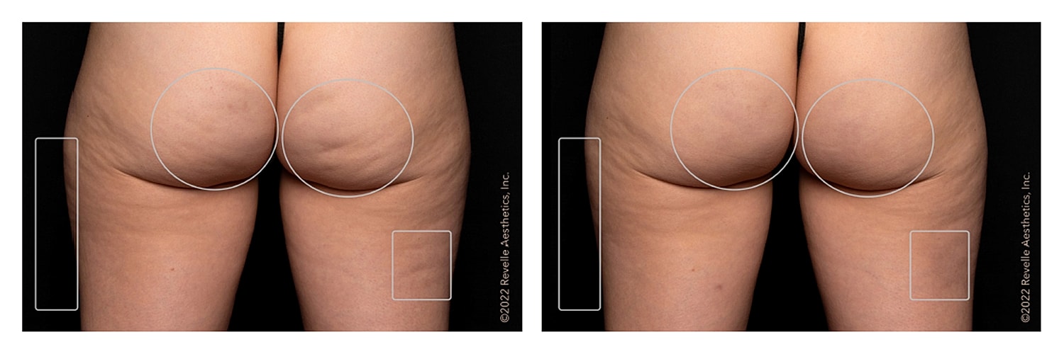 Before and after treatment for skin texture.
