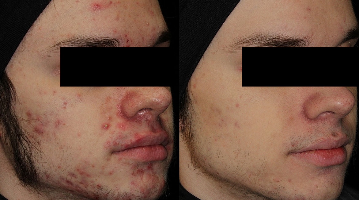Before and after acne treatment photos.