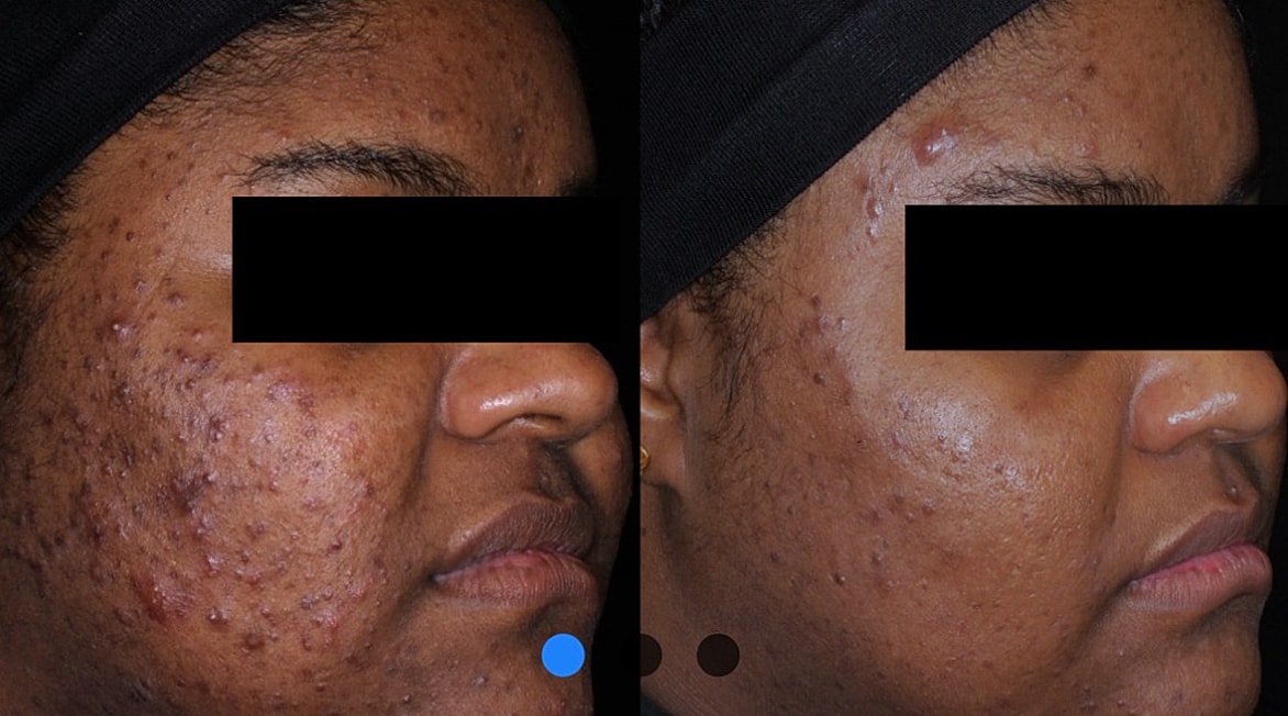 Before and after skin treatment comparison.