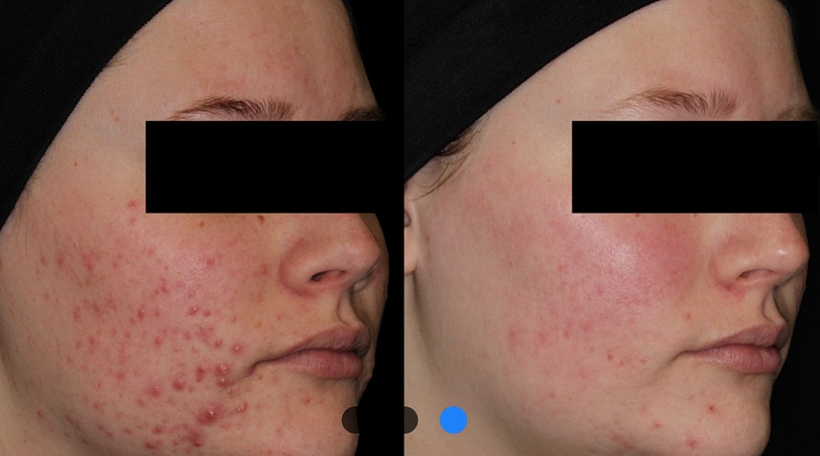 Before and after acne treatment comparison.