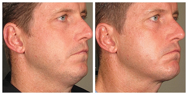 Before and after profile comparison of chin contour.