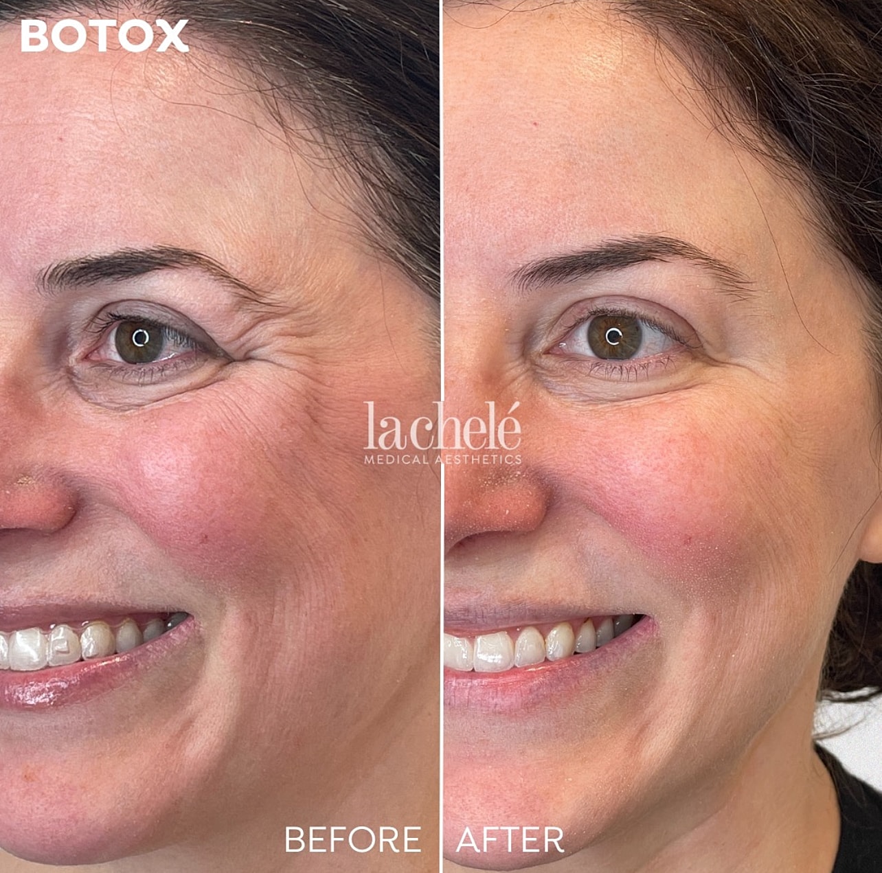 Botox treatment results: before and after comparison.