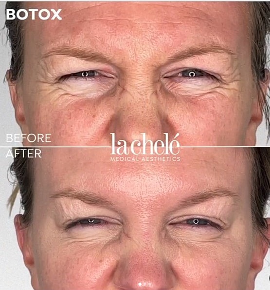Botox treatment results: before and after comparison.