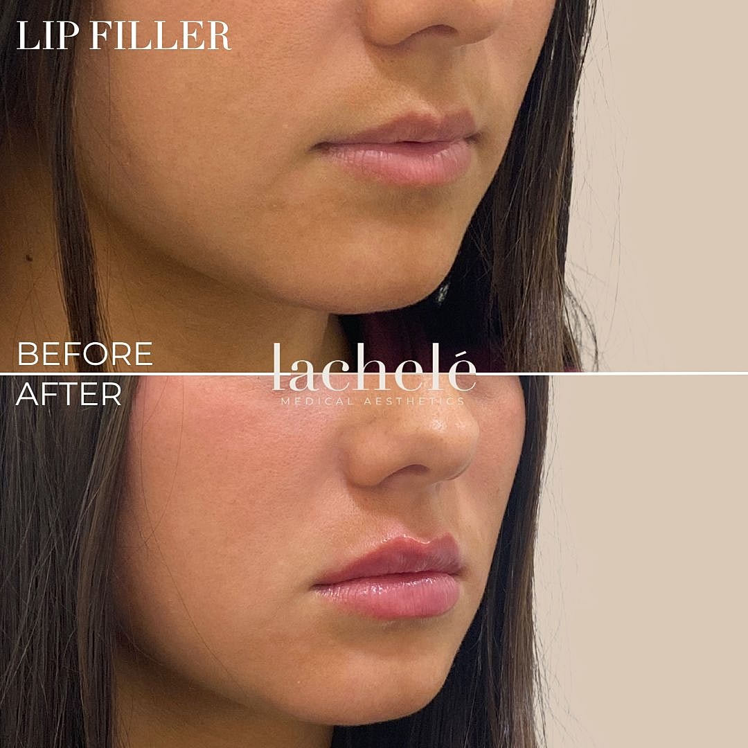 lip filler before and after