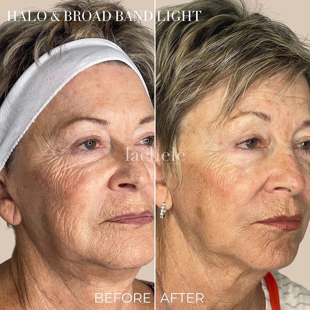 Before and after skin treatment results.