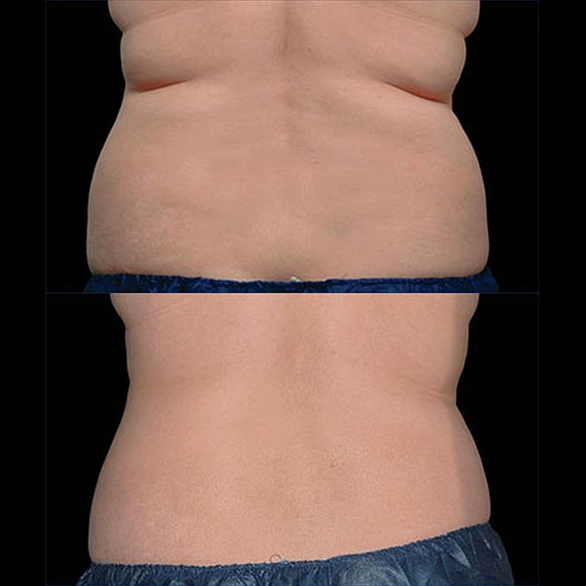 Before and after body contouring treatment images.
