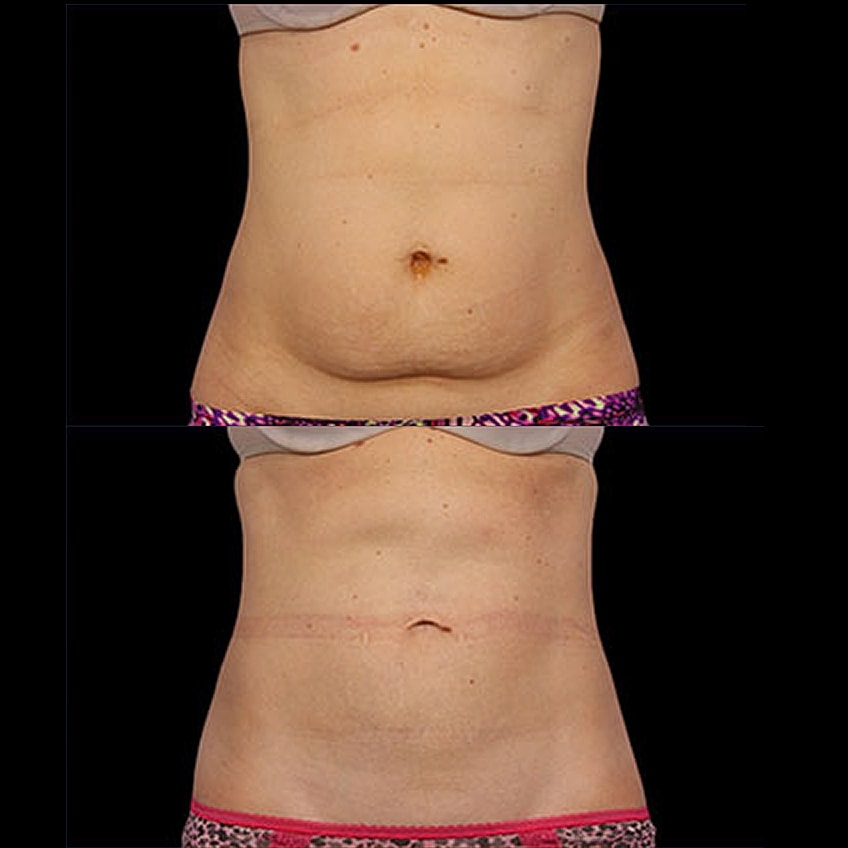 Before and after stomach appearance comparison.