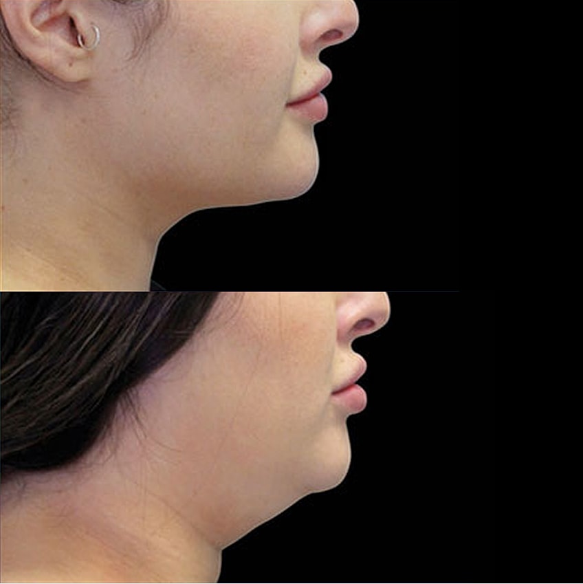 Before and after jawline transformation comparison.