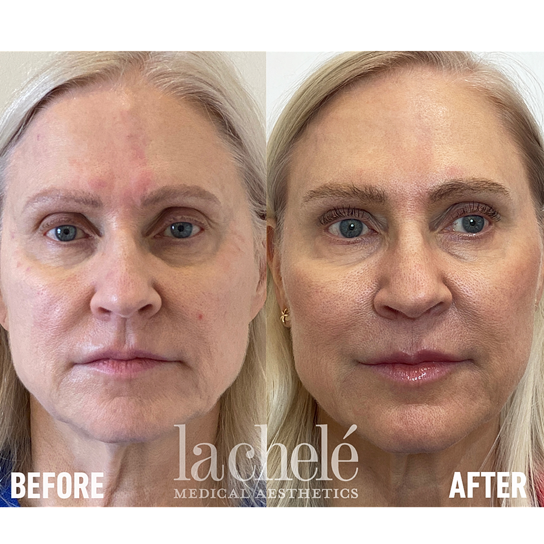 Before and after skin treatment comparison.