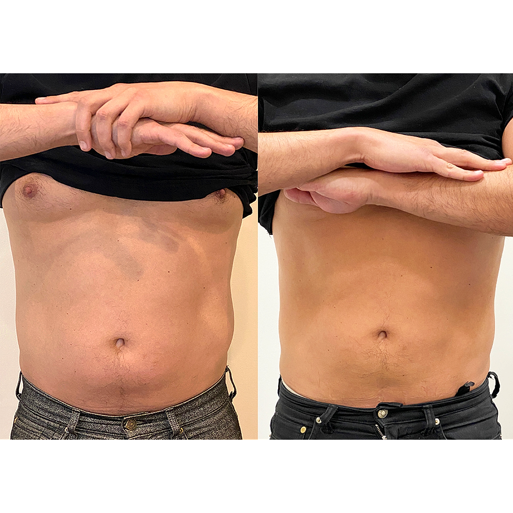 Before and after body transformation comparison.