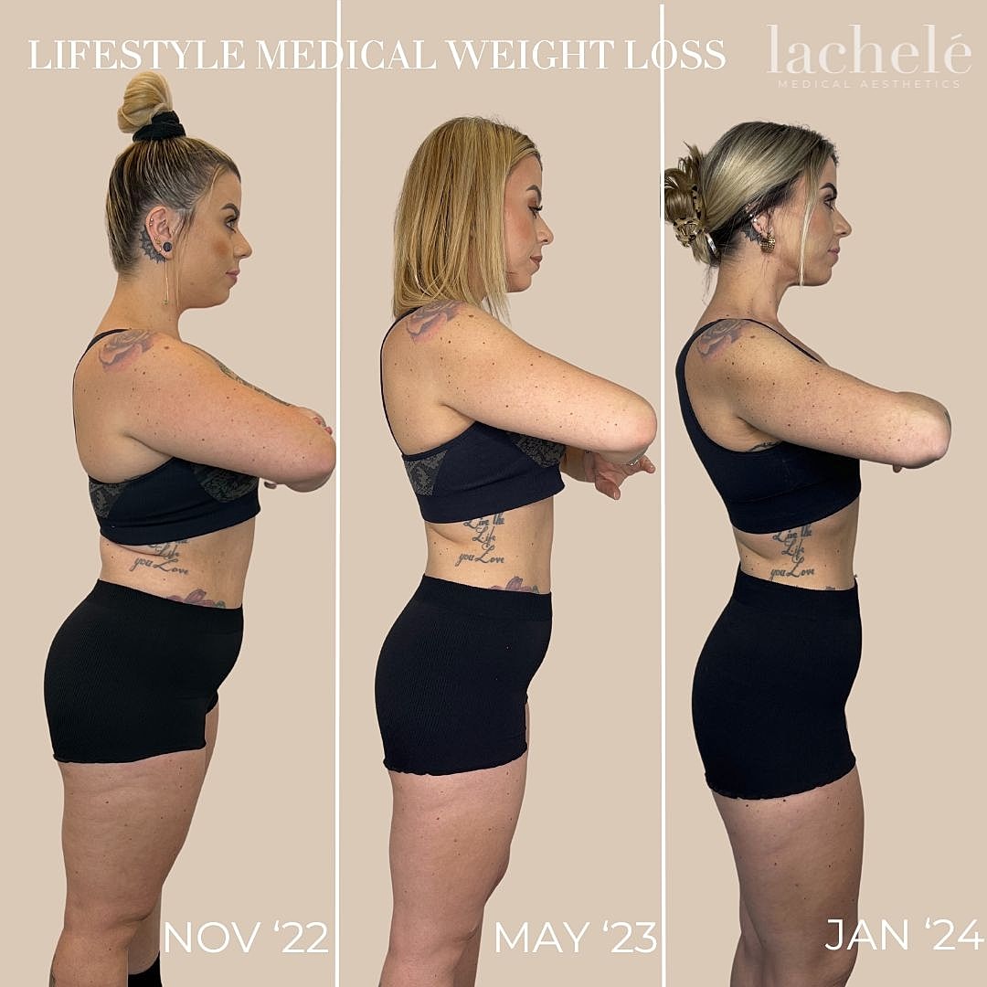 Weight loss progress over time, three photos.