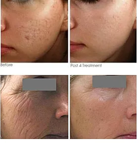 Skin treatment results: before and after images.