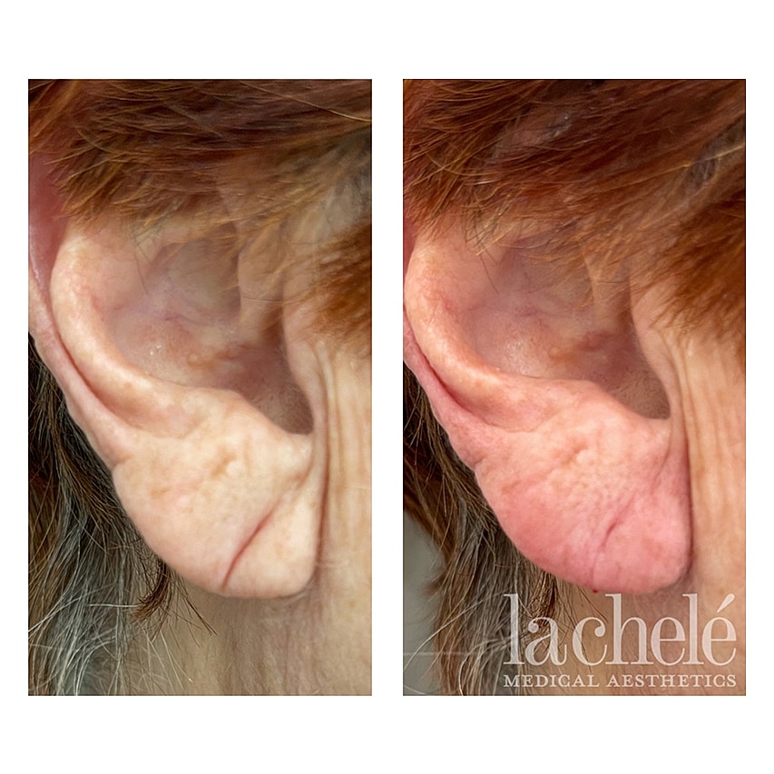 Before and after ear cosmetic procedure comparison.