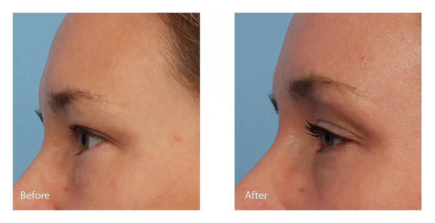 Before and after skin treatment comparison.
