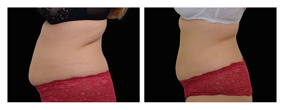 Comparison of abdominal appearance before and after.