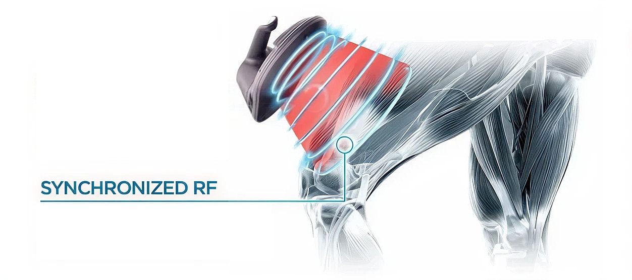 Synchronized RF technology on muscle diagram illustration.