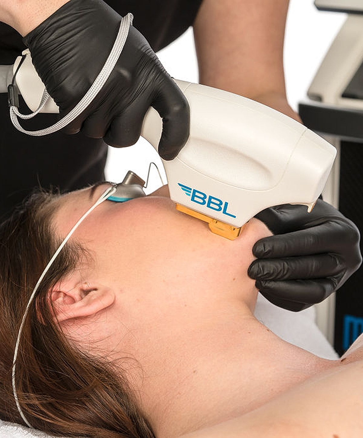 BBL treatment being performed on a patient's face.