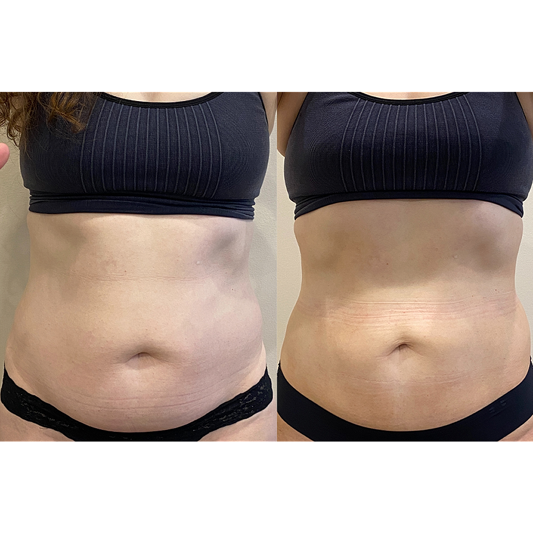 Before and after body contouring treatment comparison.