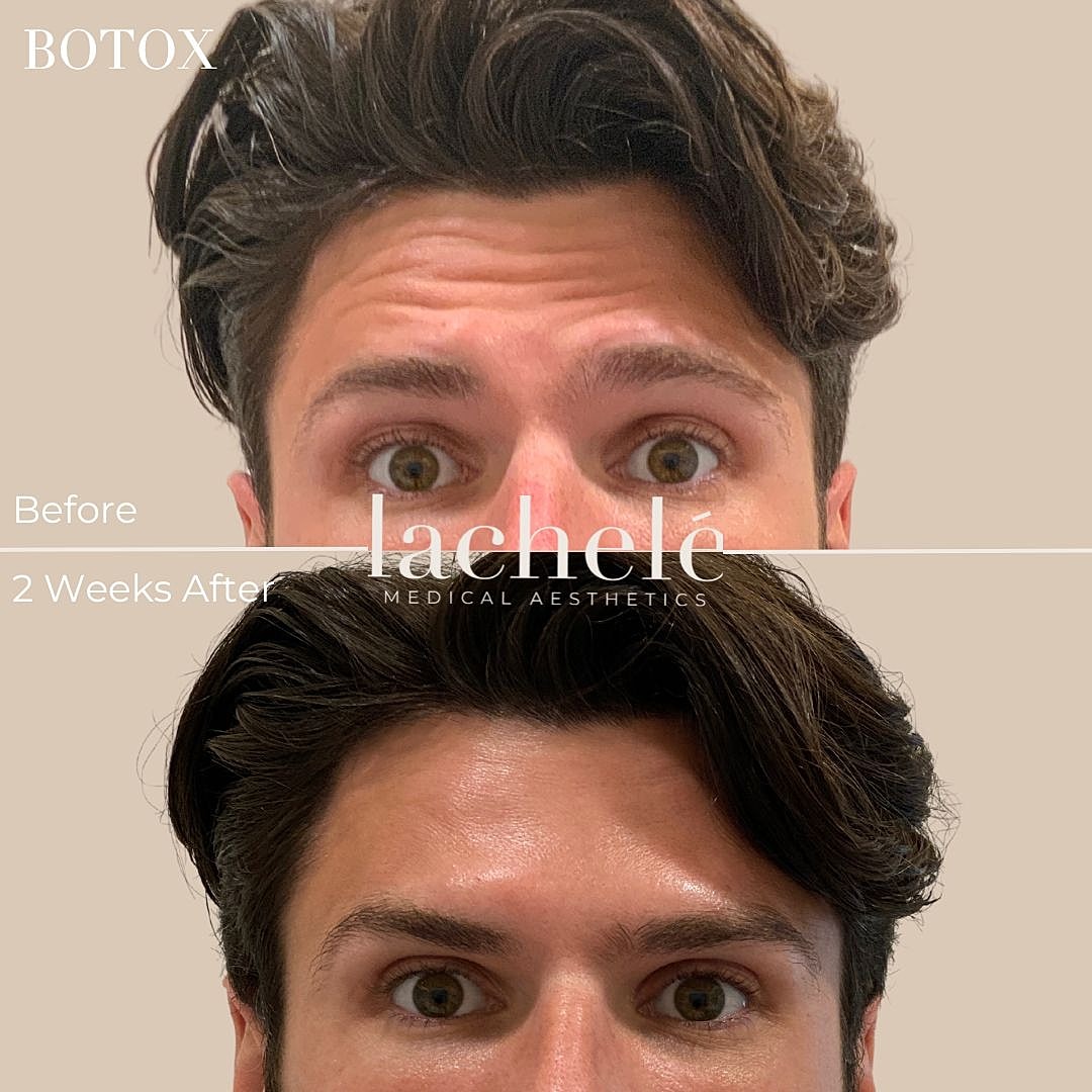 Botox treatment before and after comparison image.