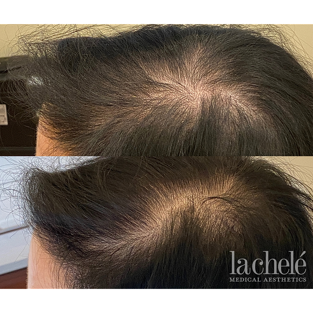 Before and after hair restoration treatment comparison.