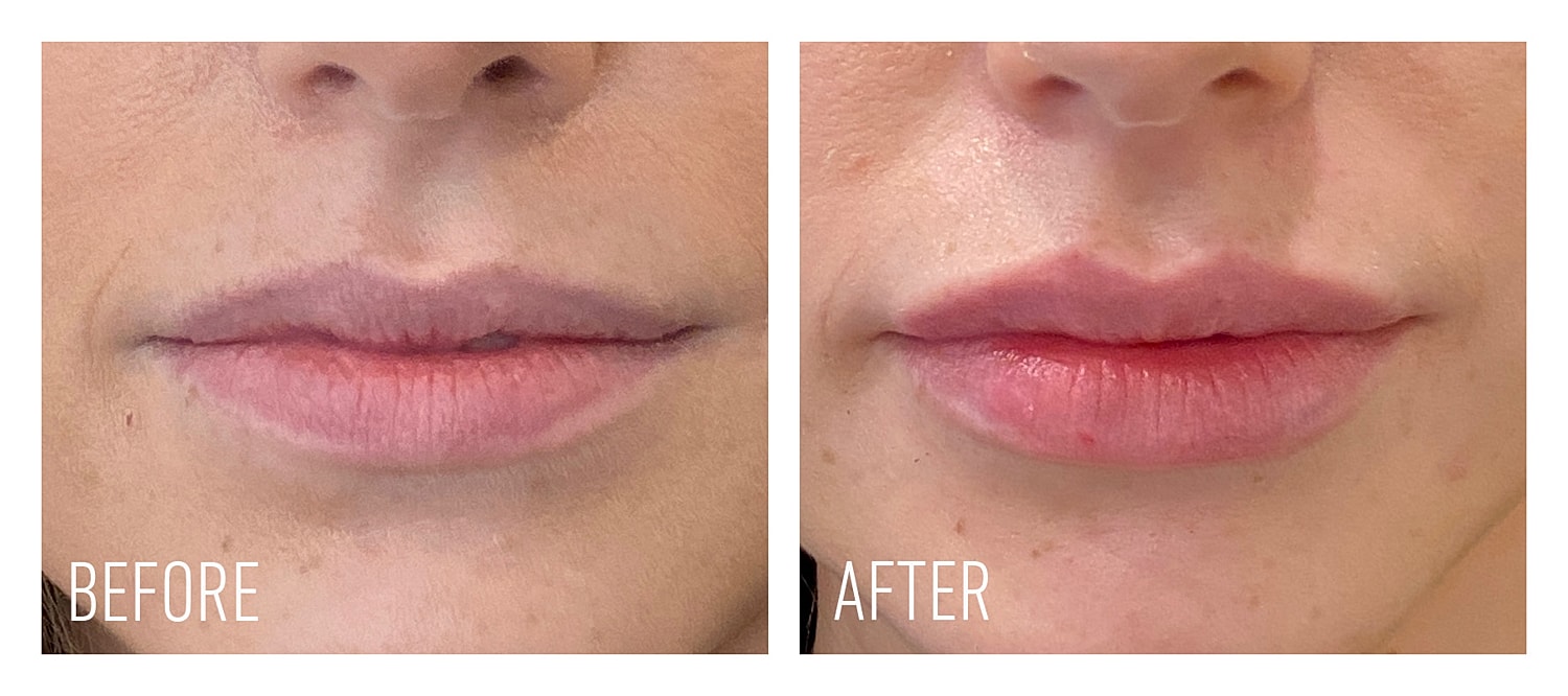 Lip enhancement before and after treatment comparison.