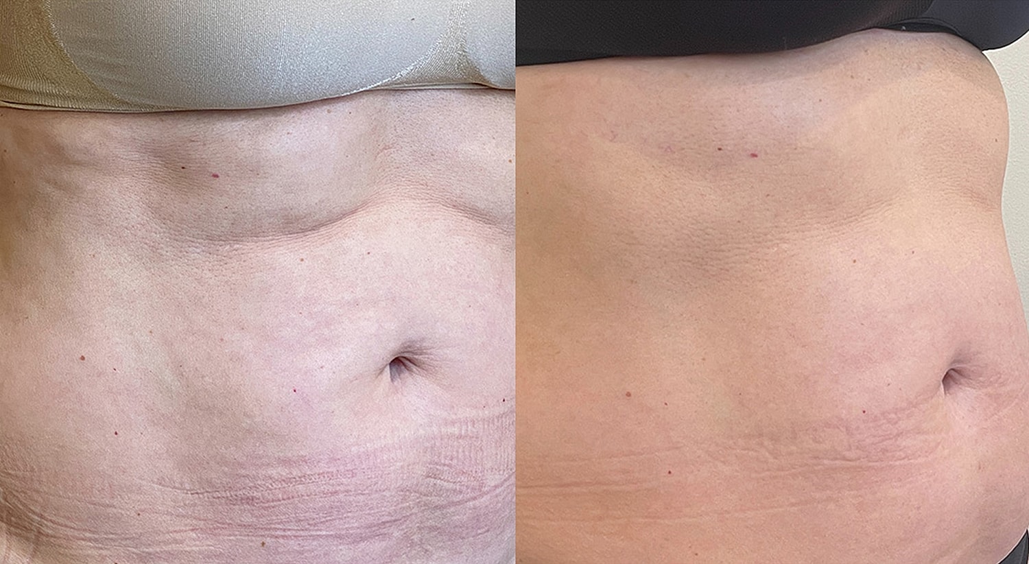Before and after abdomen appearance comparison.