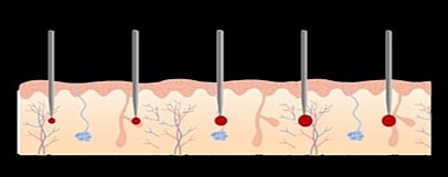 Diagram of skin layers with injection needles.
