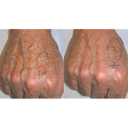 Before and after skin treatment on hands.