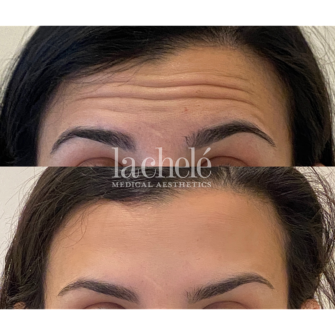Before and after eyebrow treatment comparison.