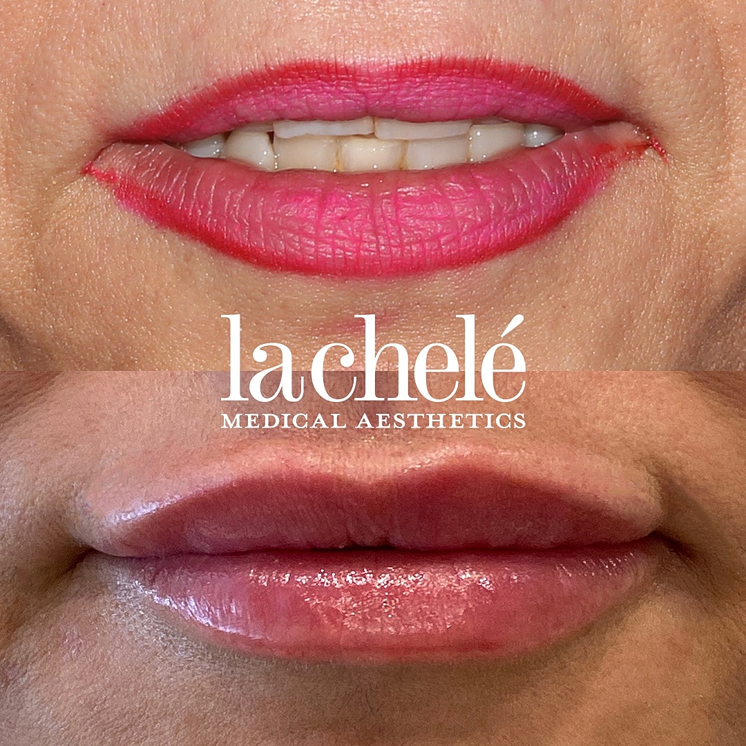 lip filler before and after