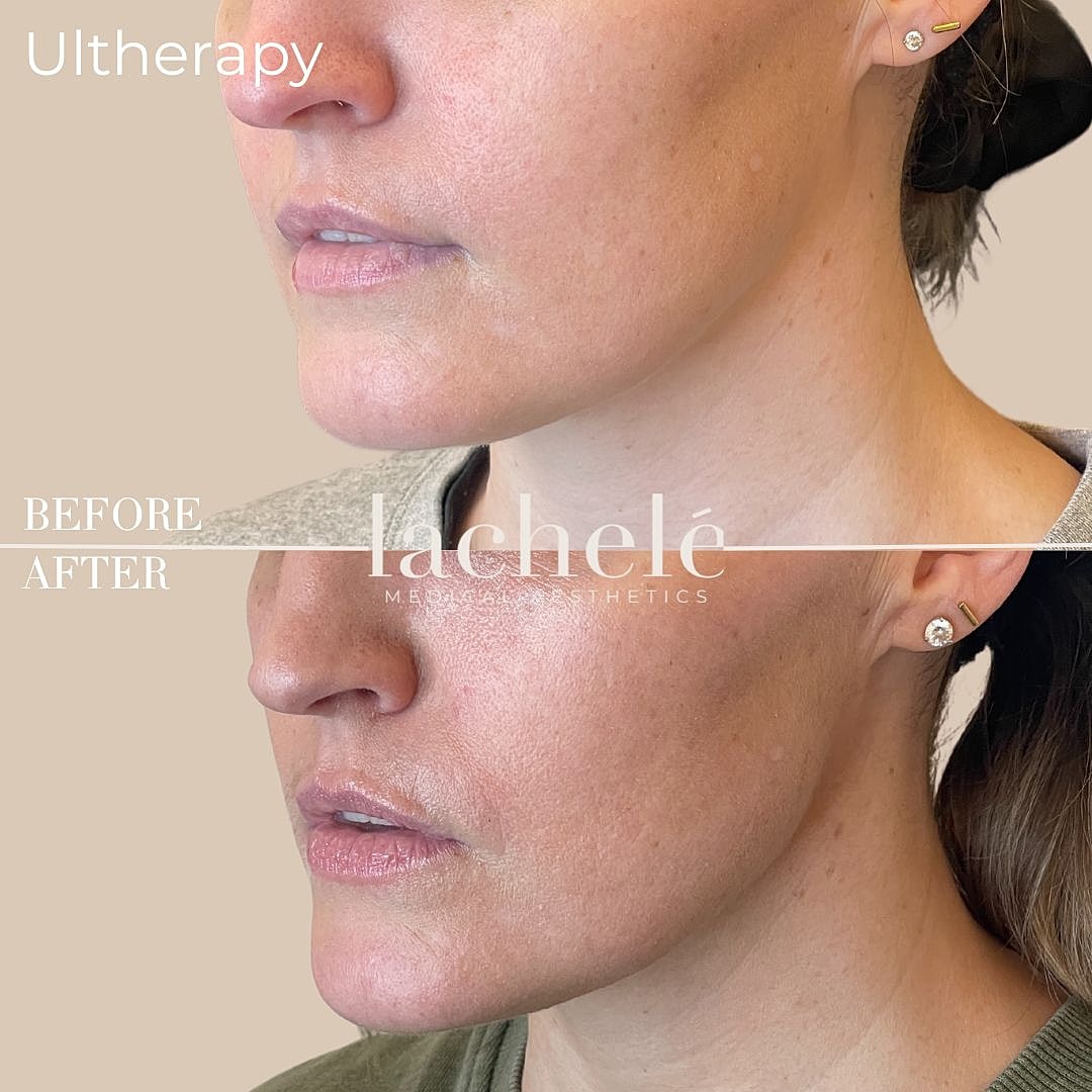 Ultherapy before and after facial treatment comparison