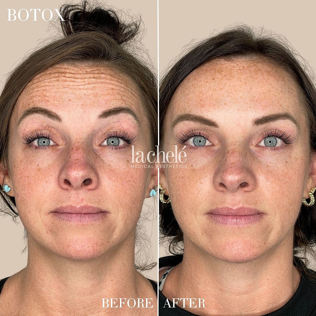 Botox before and after transformation comparison.