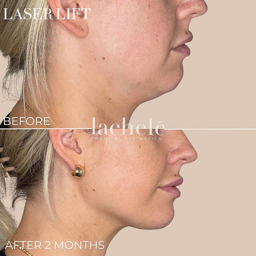 Before and after laser lift treatment results.