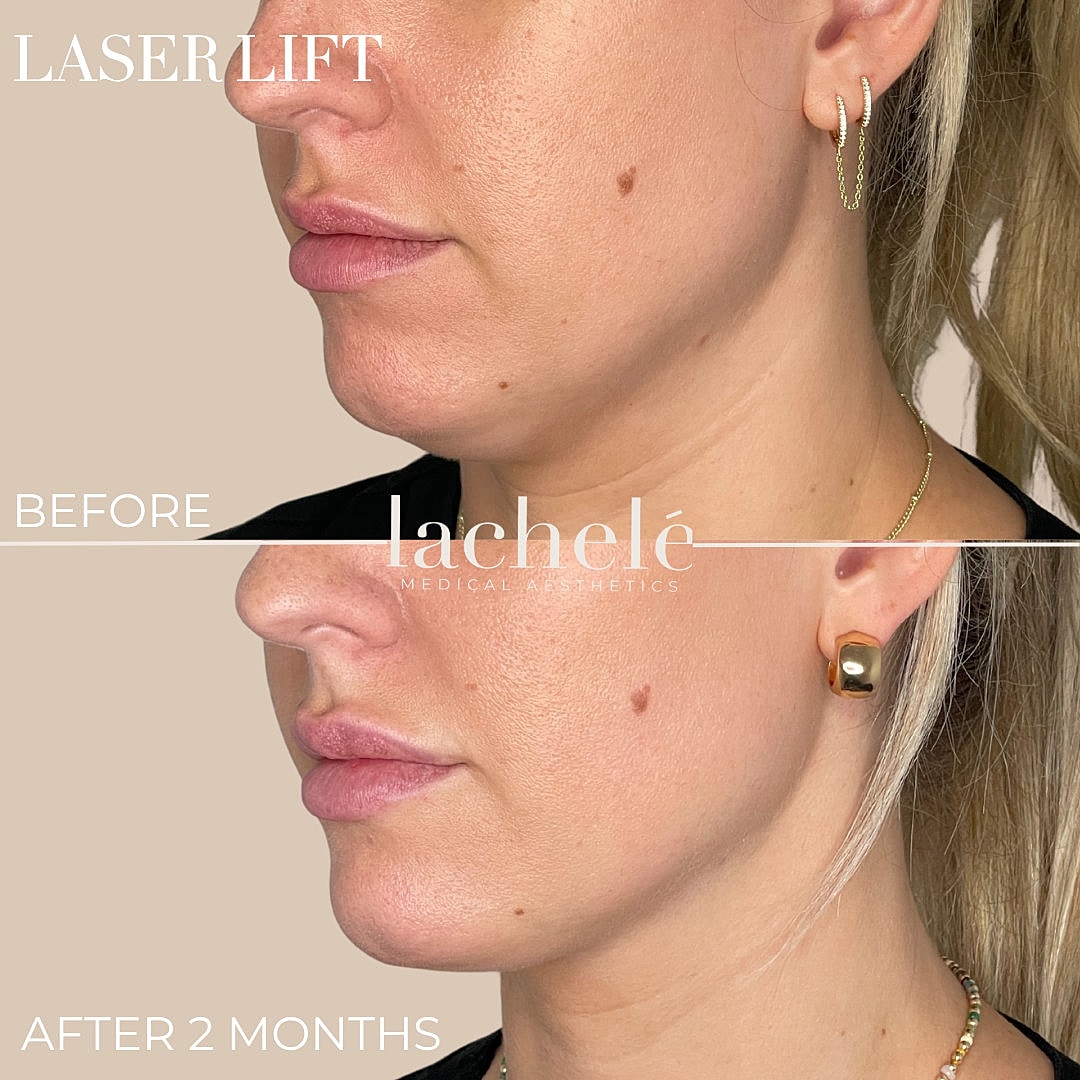 Before and after laser lift treatment comparison.
