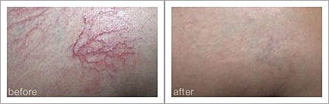 Before and after skin treatment results.
