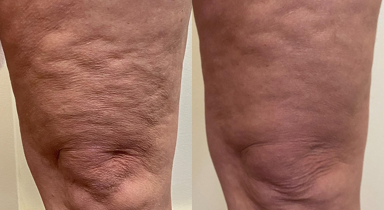 Comparison of knees with different skin textures.