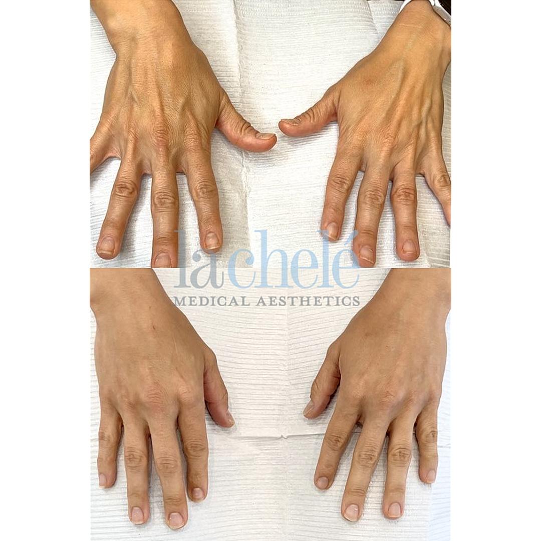 Before and after hand treatment comparison.