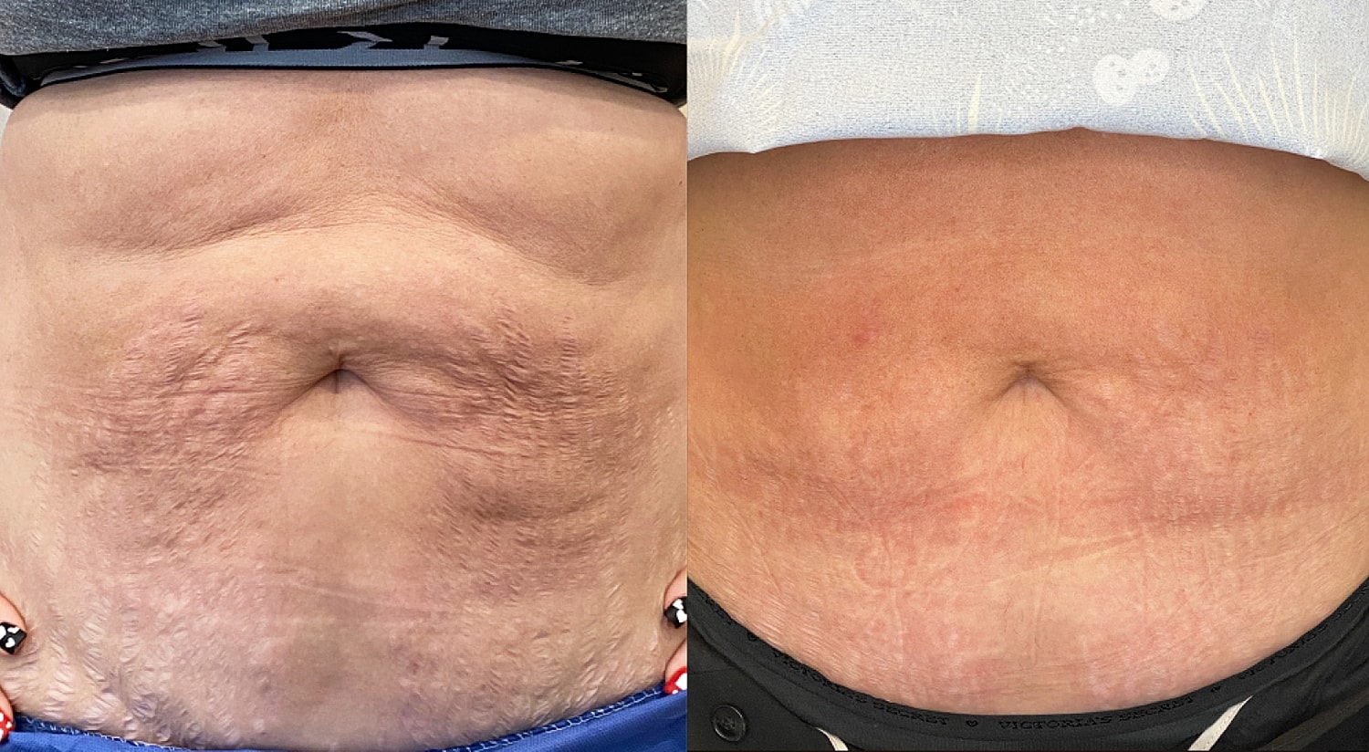 Comparison of two abdominal skin textures.