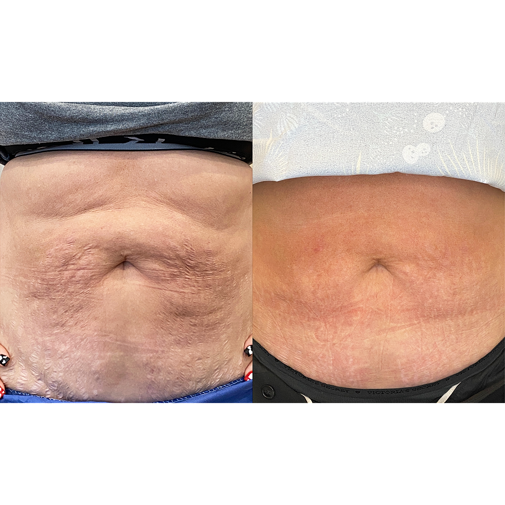 Comparison of two abdominal skin appearances.