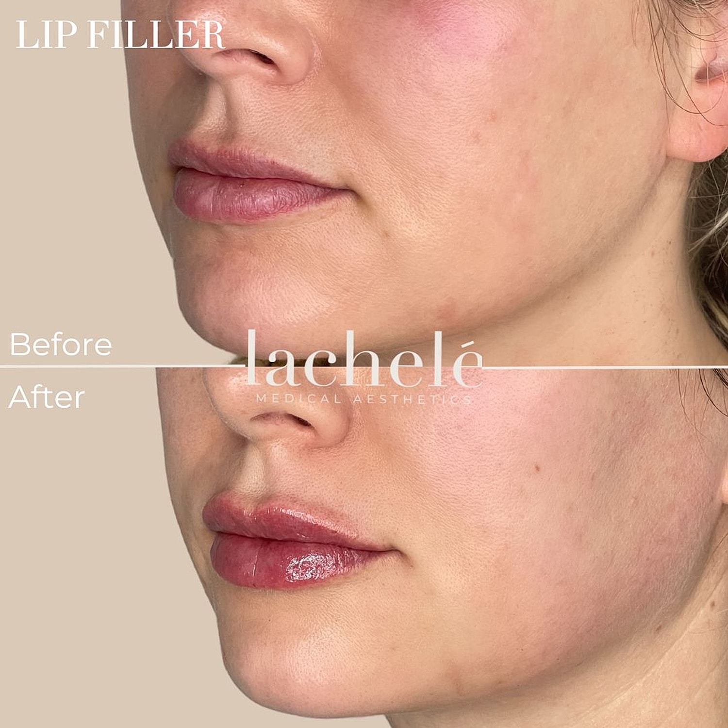 Lip filler before and after treatment comparison.