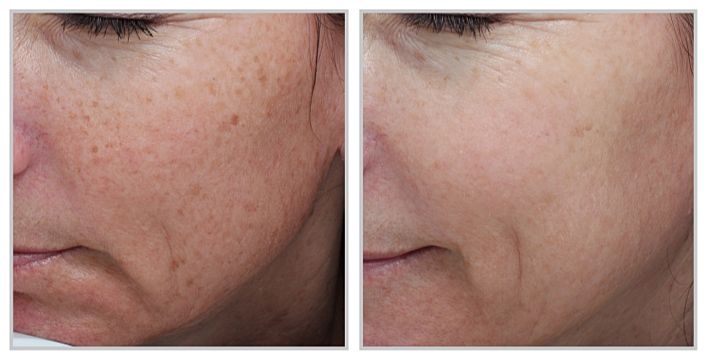 Before and after of Sciton Moxi and BBL