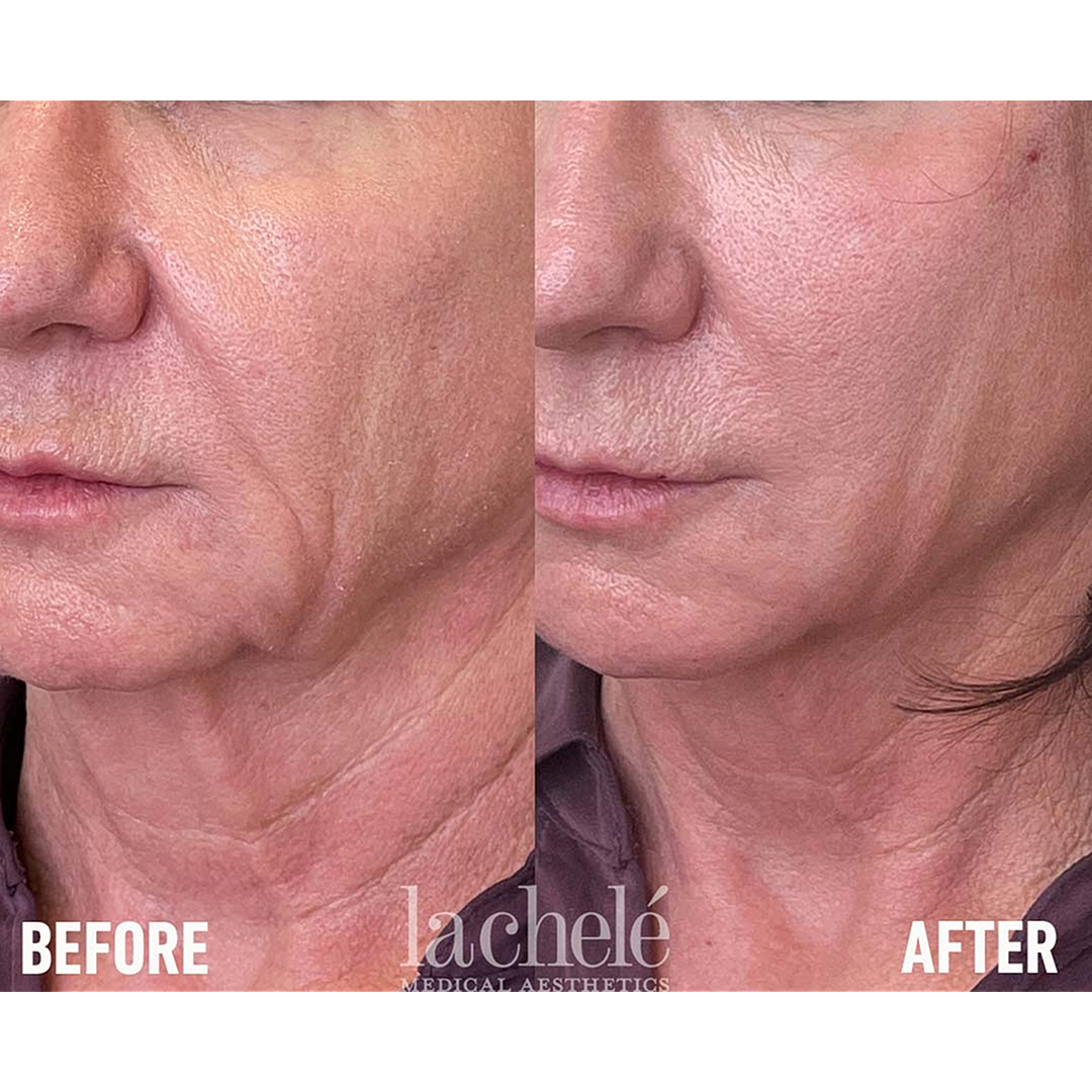 Before and after skin treatment comparison.