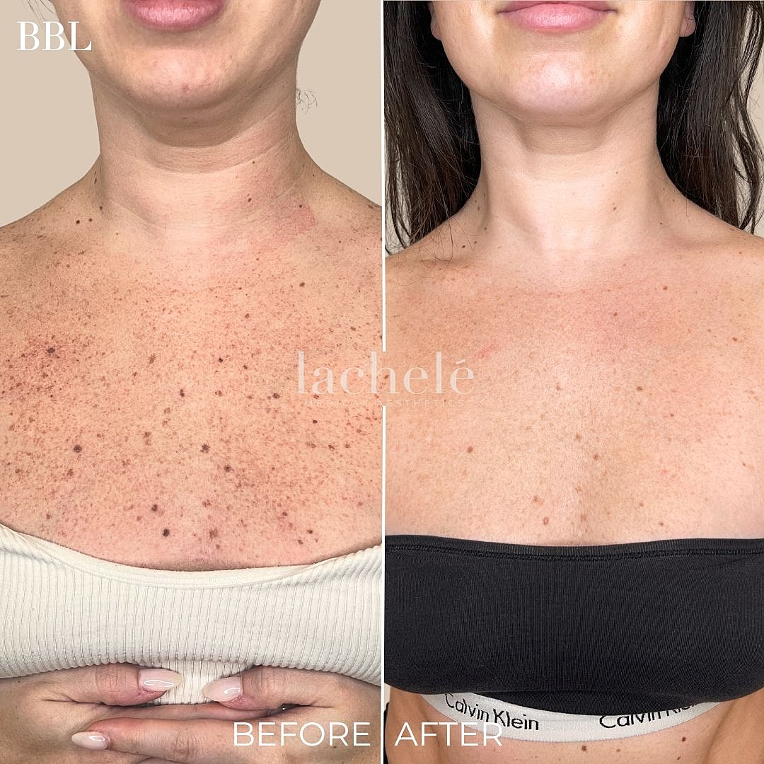 BBL skin treatment before and after results