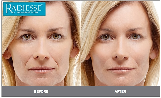 Before and after using Radiesse filler.