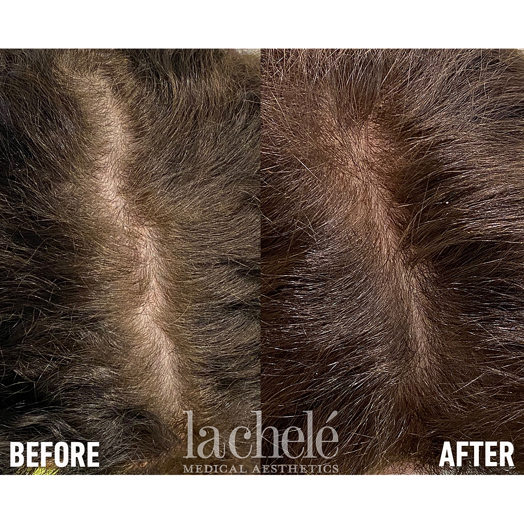Hair restoration treatment before and after comparison.