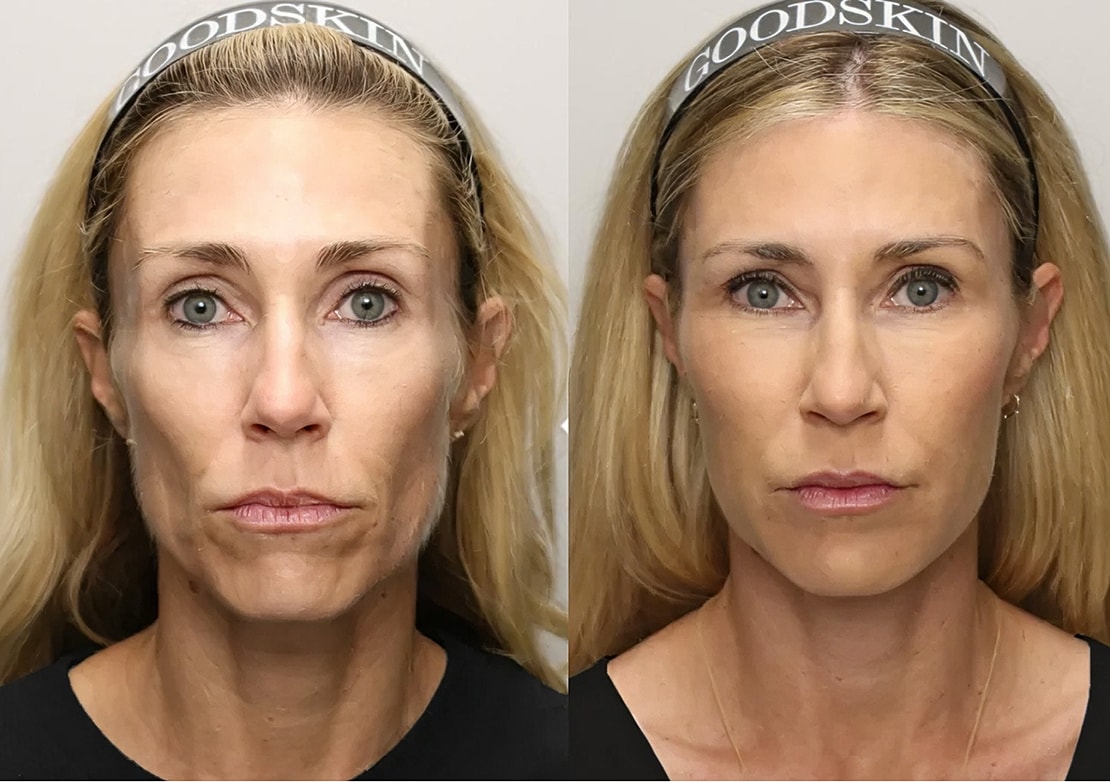 Renuva Volume Restoration