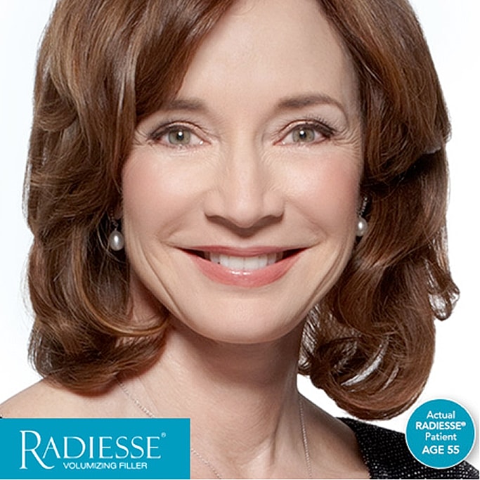 Smiling woman promoting Radiesse volumizing filler.