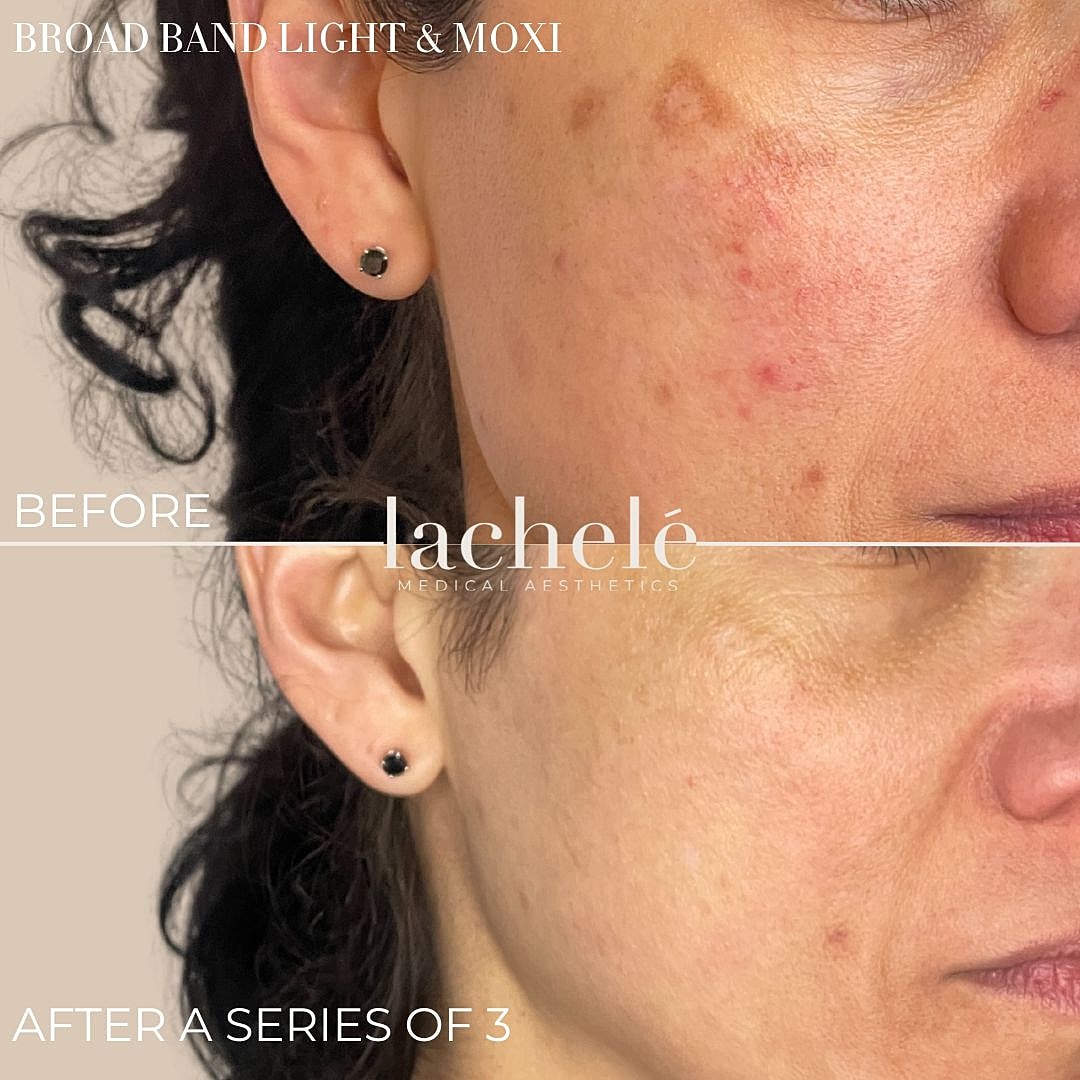 moxi before and after